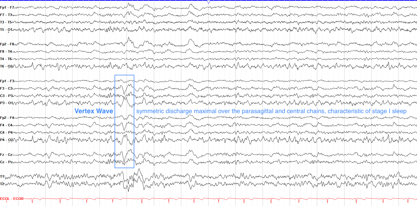 The Normal Asleep EEG
